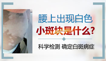 犯白癜风症状